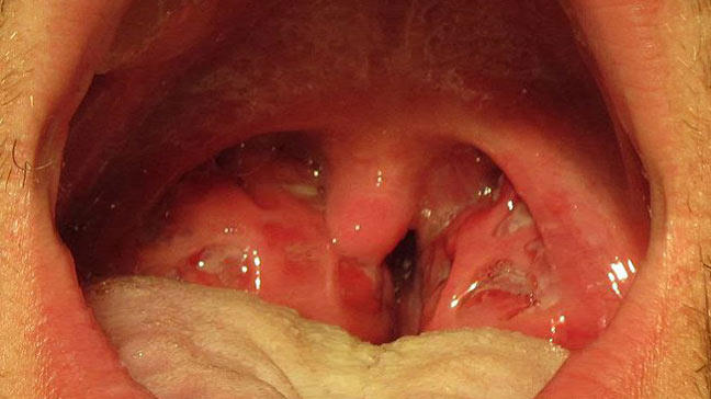 Does Strep Survive Cold Weather